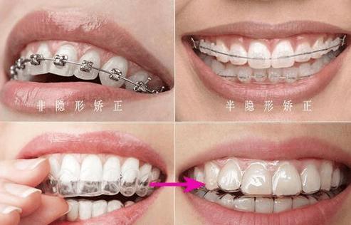 上海30多岁还能矫正牙齿吗?过来人真实经验分享