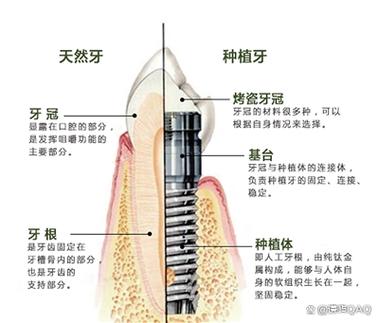 上海深圳缺牙修复:镶牙与种植牙到底哪个更省钱?