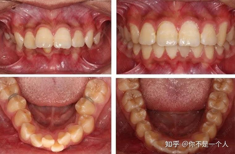 上海27岁整牙晚不晚?揭秘成年正畸的真实效果与风险