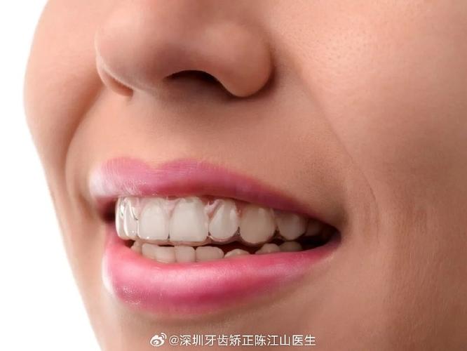 上海成年人矫正牙齿多久能好?揭秘快速整牙的真相与代价