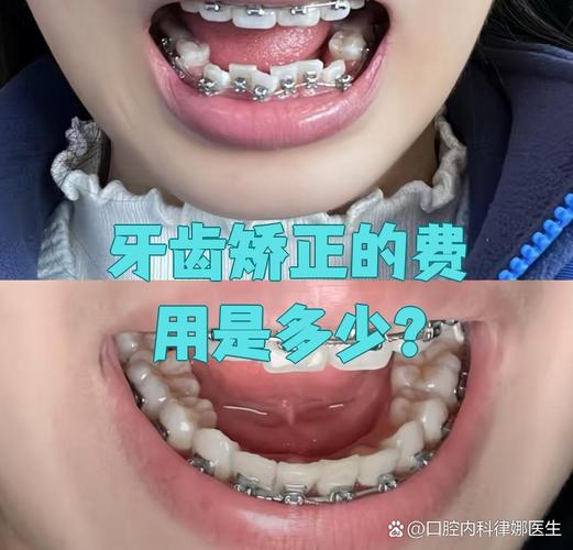 宿迁矫正牙齿要多少钱_宿迁牙齿矫正多少钱_宿迁牙齿矫去医院还是去机构
