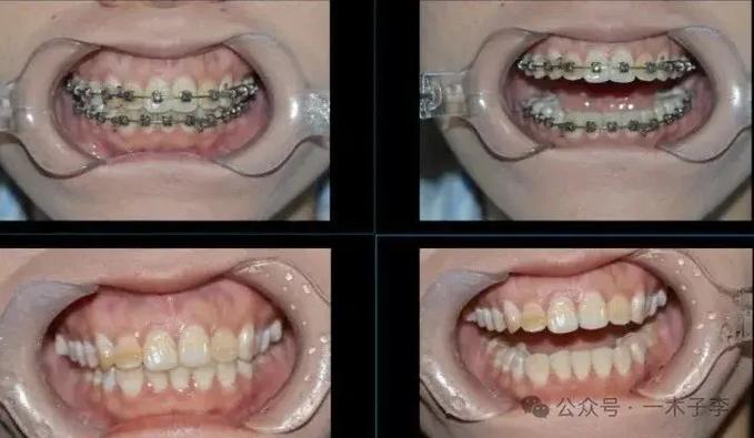 上海30岁矫正牙齿有什么危害?把坑说透了再决定