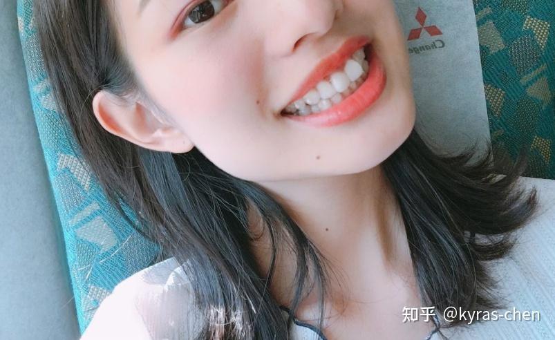 上海成人门牙不齐矫正真的很简单吗