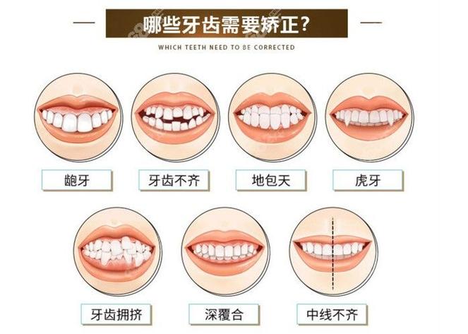 深圳治疗地包天哪家医院好_儿童地包天矫正医院_深圳儿童地包天最佳矫正年龄