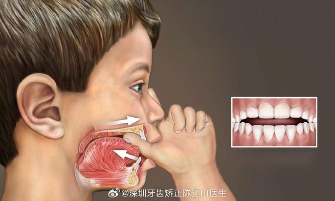 上海深圳孩子地包天几岁治最好？牙医揭秘黄金期