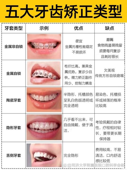 上海21岁矫正牙齿不晚!成人正畸时长与效果解析
