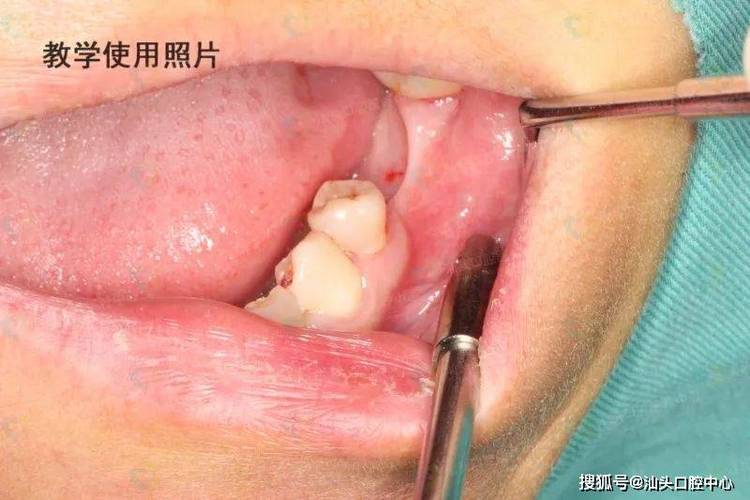 上海没有牙骨也能种牙？医生说实话
