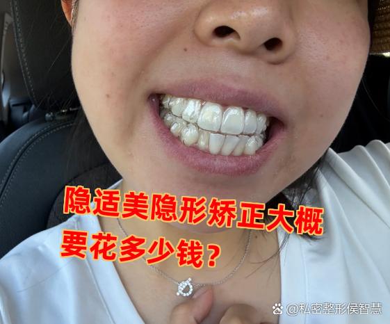 上海深圳龙岗隐适美牙套到底多少钱？2026年最新价格大揭秘