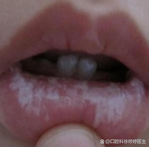 上海儿童口腔有白色黏膜到底严不严重