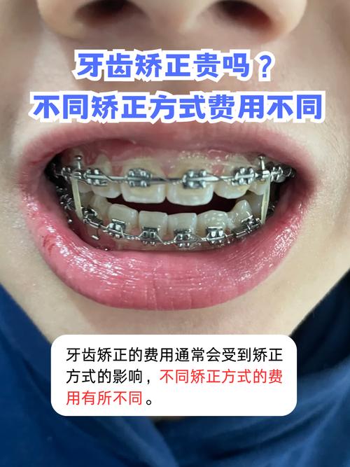 宝鸡矫正牙齿哪个医院好_宝鸡牙齿矫正价格多少钱_宝鸡箍牙价格