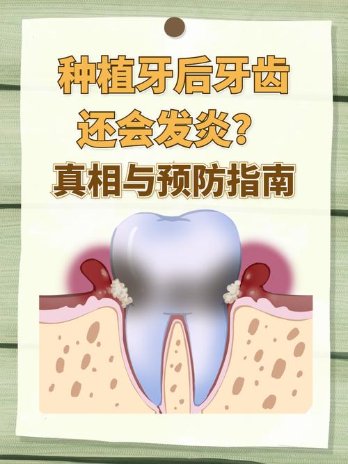 上海种植牙严重松动发炎,什么情况需要拔除?