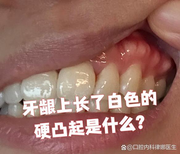 上海缺一颗牙一定要种吗 不种的后果你承受得起吗