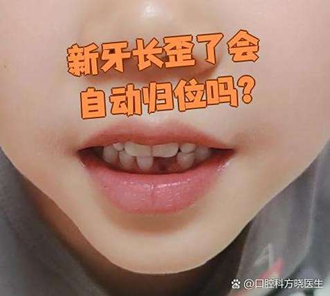 上海六岁孩子门牙长歪先别慌 看这几种矫正办法