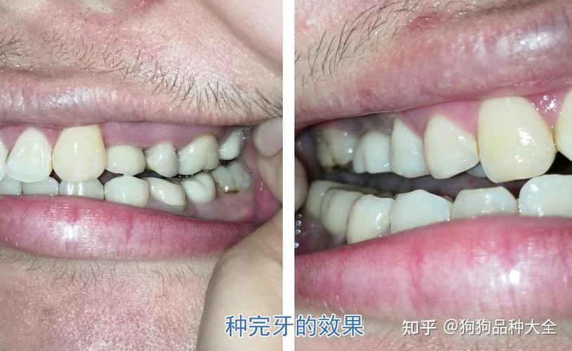 上海赤峰种植牙哪里好 公立三甲靠谱推荐