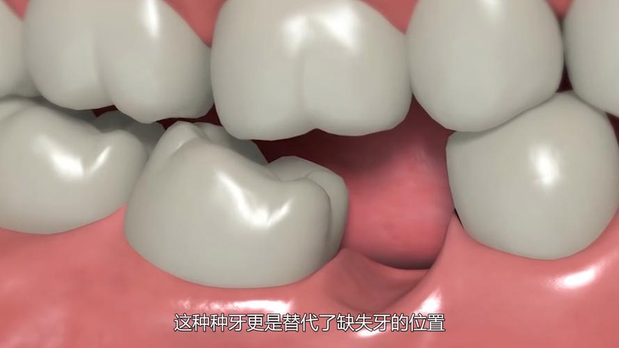 上海种牙到底疼不疼?一篇说清楚植牙真相