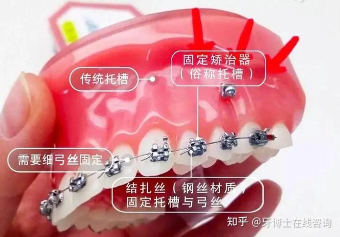 上海深圳龙岗做隐适美矫正到底要花多少钱?