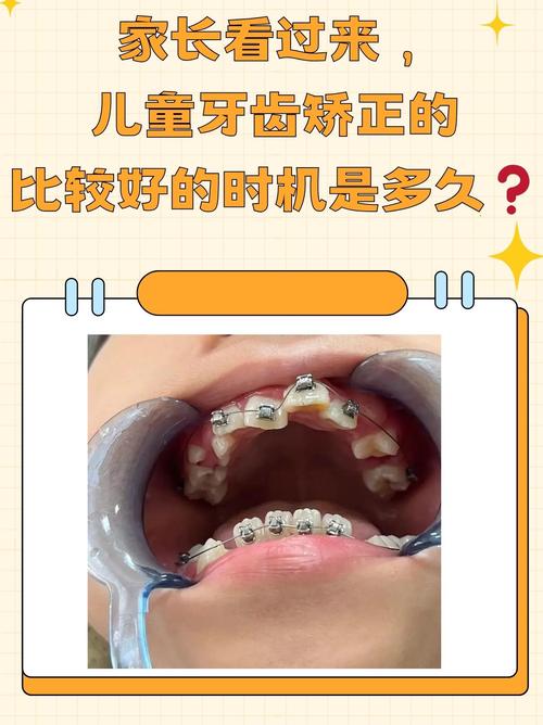 上海8岁做牙齿矫正不早!关键看这几种情况