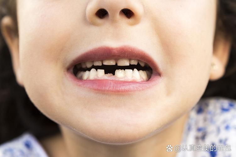 上海8岁孩子牙齿矫正哪种方法好