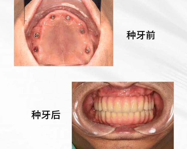 上海全口种植牙手术到底怎么做