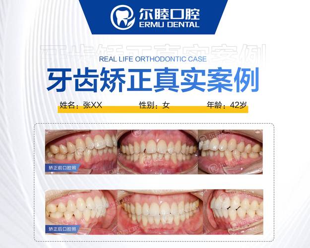 上海深圳三十岁正畸多少钱 最新收费标准一览