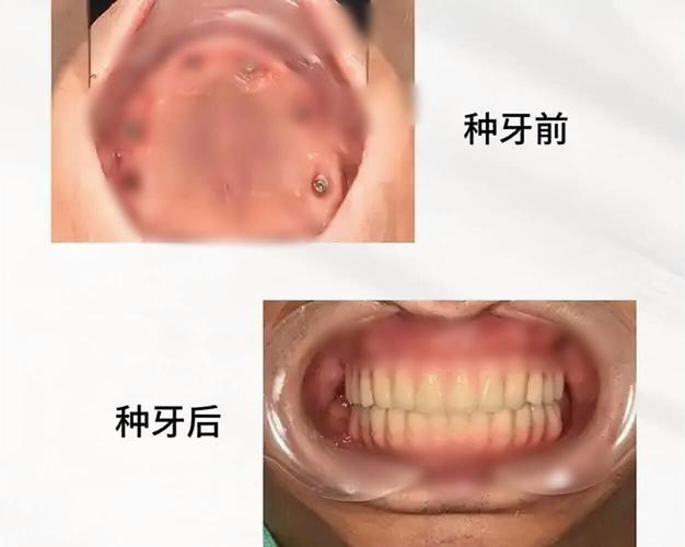 上海70多岁还能种牙吗?种牙风险大不大?
