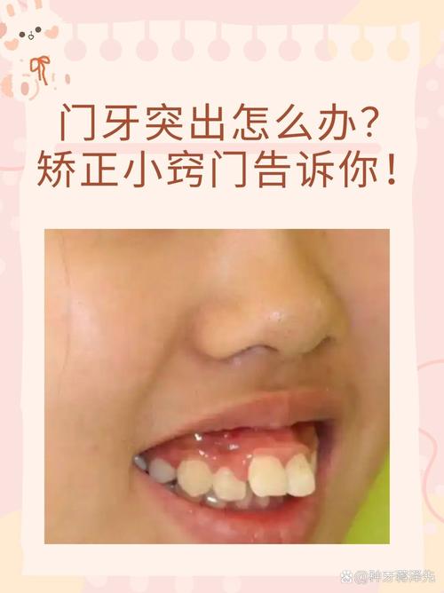 上海10岁孩子门牙突出,医生揭秘:抓住黄金期,这个最快