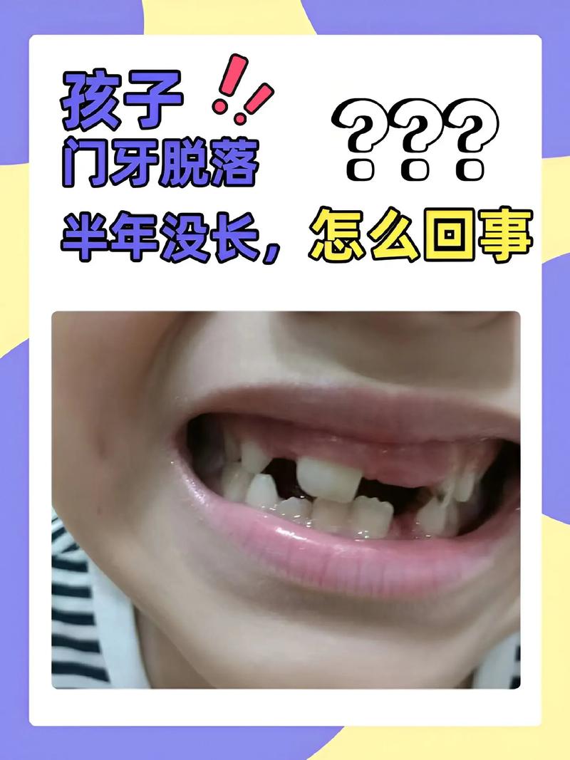 门牙突出矫正视频_10岁儿童门牙突出最快矫正方法_矫正突出门牙儿童方法图片