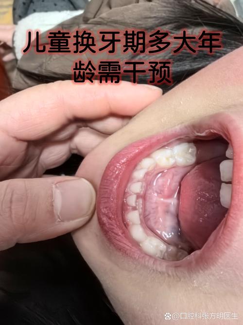 门牙突出矫正视频_10岁儿童门牙突出最快矫正方法_矫正突出门牙儿童方法图片