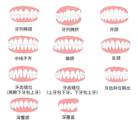上海30岁做牙齿矫正到底值不值 利与弊全分析