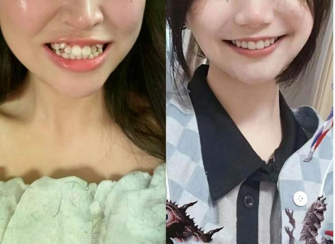 上海36岁还能矫正牙齿吗 成人正畸的真相与风险