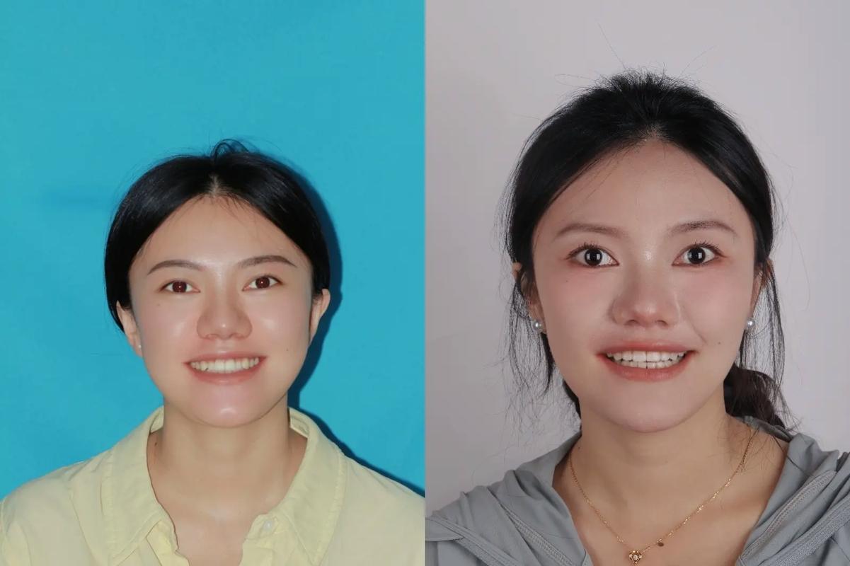 上海20岁矫正牙齿晚不晚?过来人告诉你真实答案