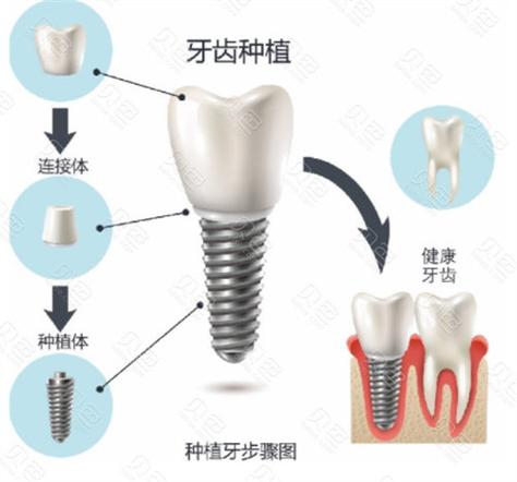 上海九江威高种植牙多少钱一颗2026最新价格