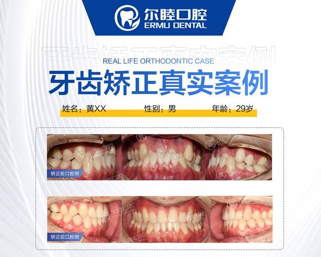 上海深圳南山做MRC矫正哪家医院靠谱?