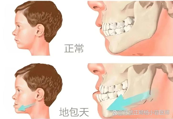 上海12岁小孩能做牙齿矫正吗?别等换完牙才后悔