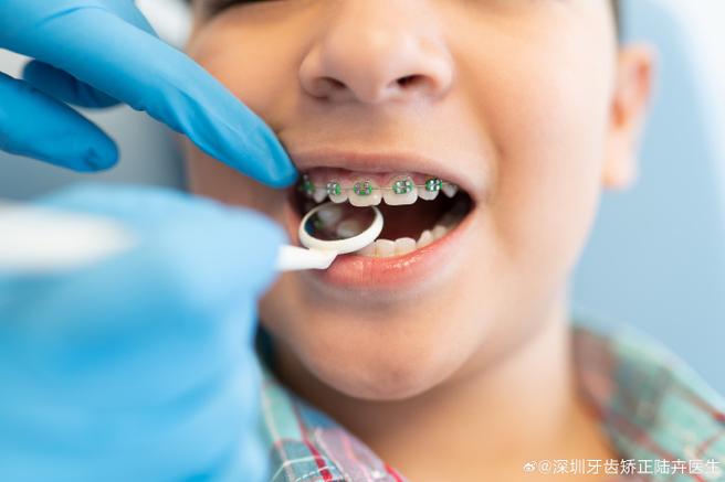 上海8岁孩子门牙龅牙矫正方法 儿童早期干预怎么做
