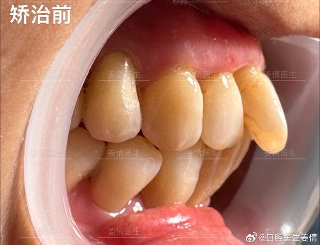 上海60岁还能做牙齿矫正吗