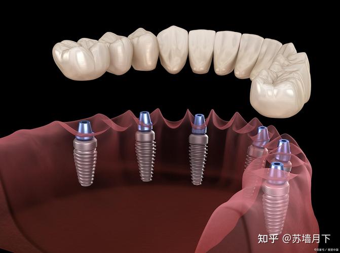 上海深圳福田种一颗牙要多少钱?价格剖析