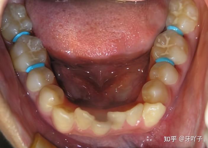 上海玉林牙齿矫正效果怎么样？看完这篇就心里有数了
