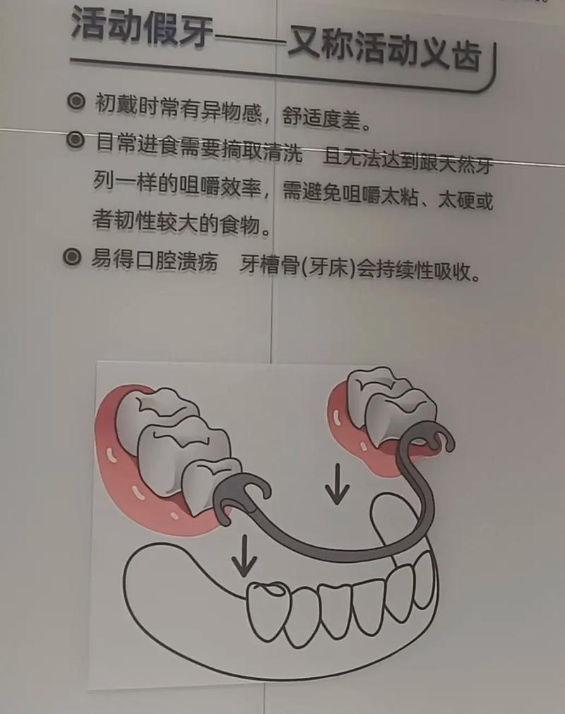 上海活动假牙固定假牙种植牙哪个好 牙医一次说清别再被忽悠