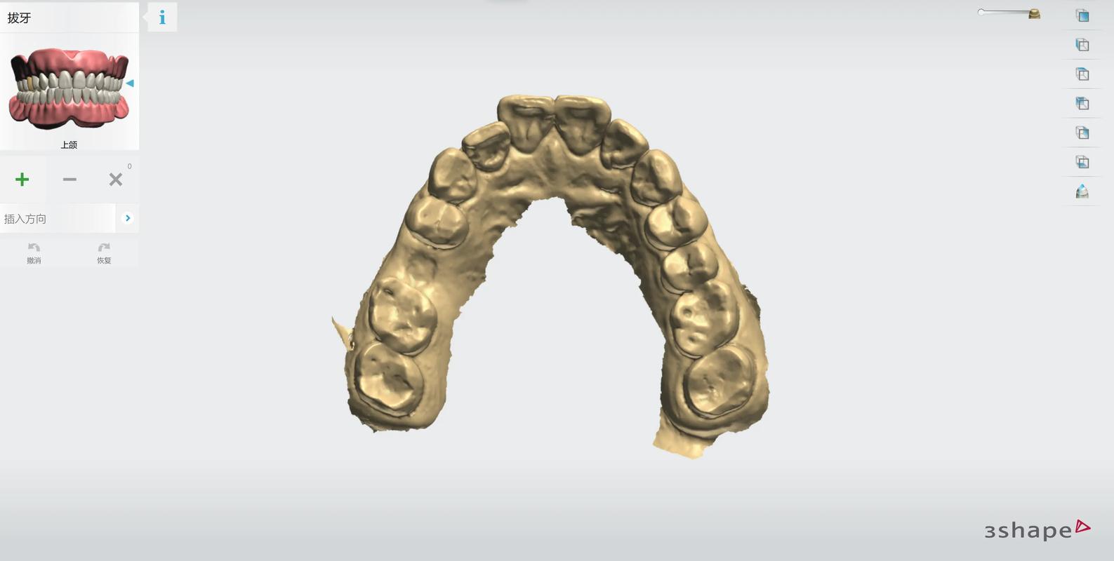 上海3D导板数字化种植牙:告别传统盲种,种牙更精准更安心
