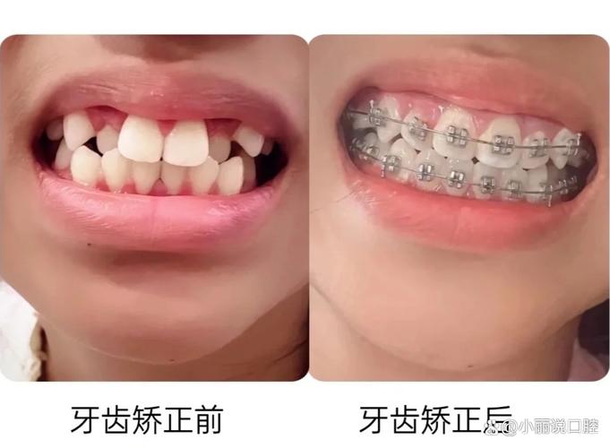 上海15岁牙齿不齐怎么办 专家说三种矫正方式哪种最适合你