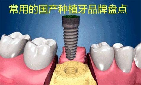 上海深圳百康特种植牙多少钱？最新优惠看这里