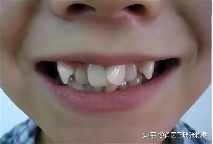 上海深圳儿童地包天最佳矫正年龄是多少?别等换牙误了大事