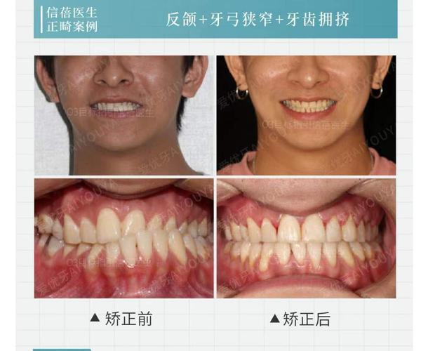 上海深圳中学生牙齿矫正优惠活动真的靠谱吗?