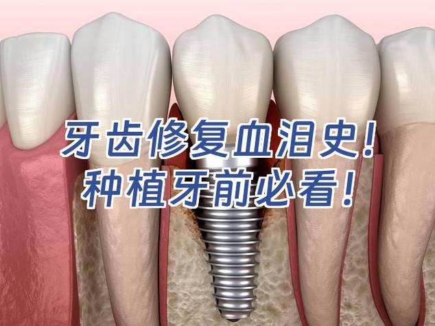上海种植牙失败了怎么办 修复费用要多少才合理
