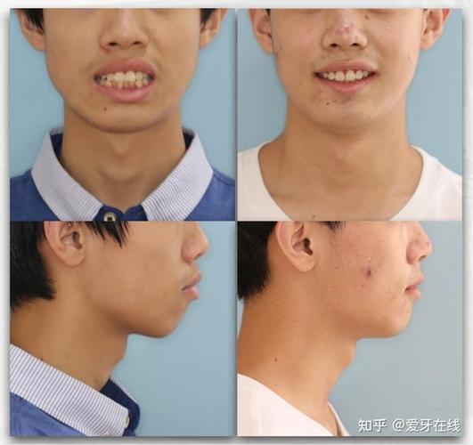 上海呼和浩特牙齿矫正靠不靠谱?效果真实揭秘