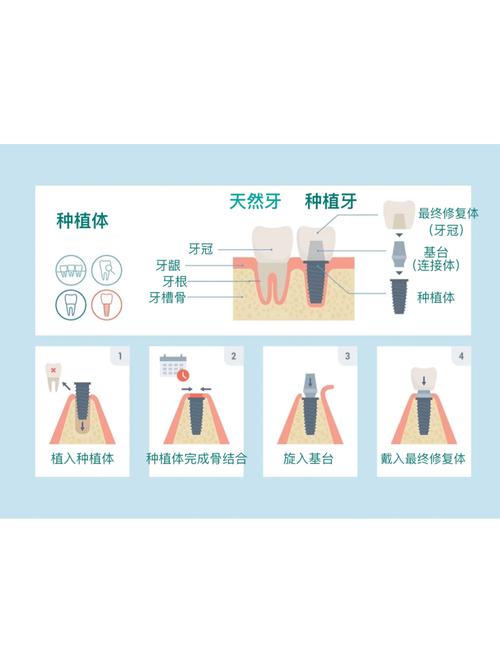 牙齿脱落一颗种牙多少钱_脱落的牙齿可以种回去吗_牙齿脱落 种牙