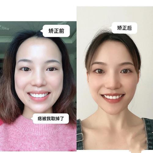 上海成年人牙齿矫正还来得及吗