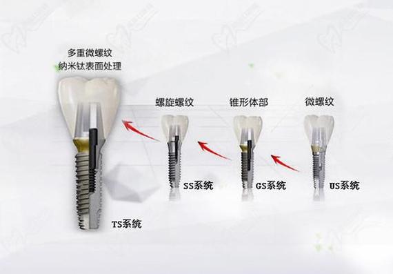 上海唐山韩系奥齿泰种植牙2026最新费用一览