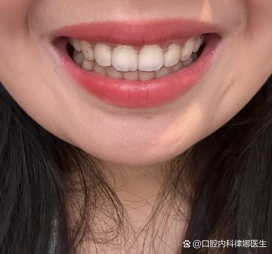 上海23岁牙不齐还能整吗?正畸黄金期过了没